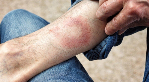 Зросла кількість випадків хвороби Лайма у Полтавській області